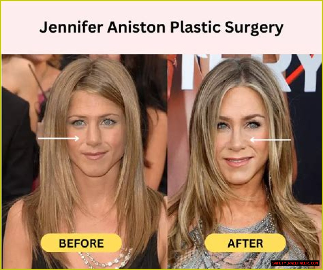 Did Jennifer Aniston Have Nose Surgery