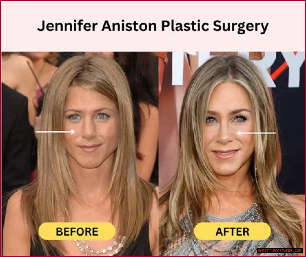 Jennifer Aniston Have Plastic Surgery