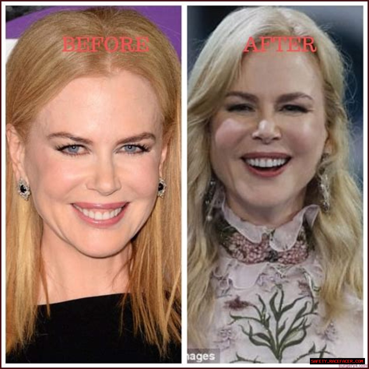 Nicole Kidman's 'Lioness' Plastic Surgery: Uncovering Hidden Truths